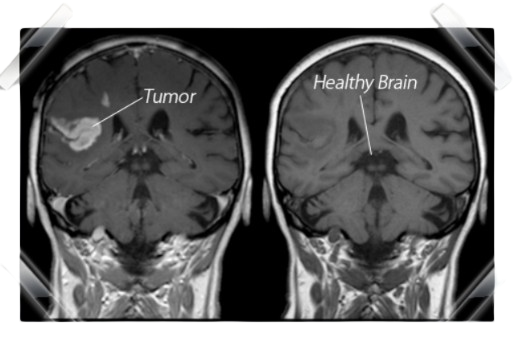 Meridian Health Protocol Tumor vs healthy brain