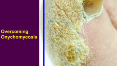 Overcoming Onychomycosis Reviews