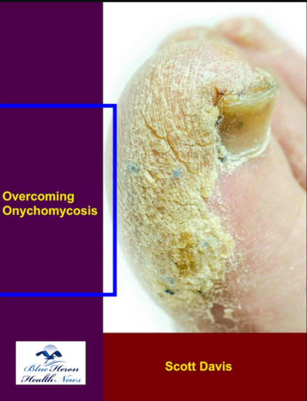 Overcoming Onychomycosis Reviews
