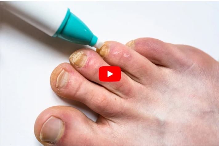 Okita Toenail Fungus Pen