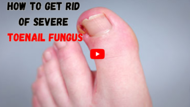 How to Get Rid of Severe Toenail Fungus