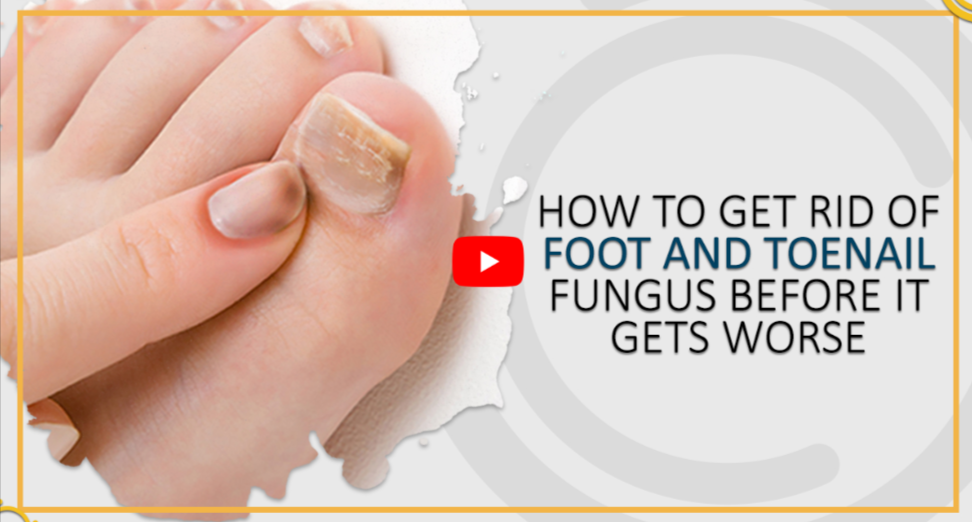 How to Get Rid of Severe ToenailFungus