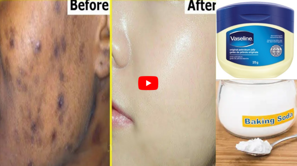 Baking Soda with Vaseline for DarkSpots