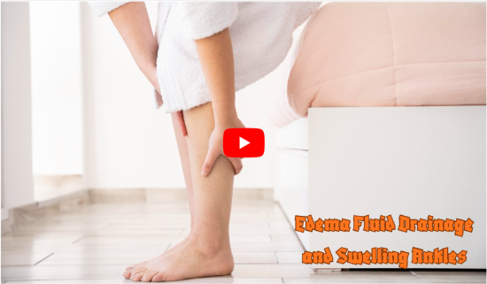 Edema Fluid Drainage and SwellingAnkles
