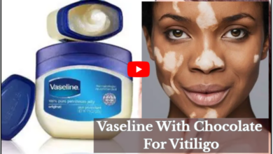 Vaseline With Chocolate For Vitiligo