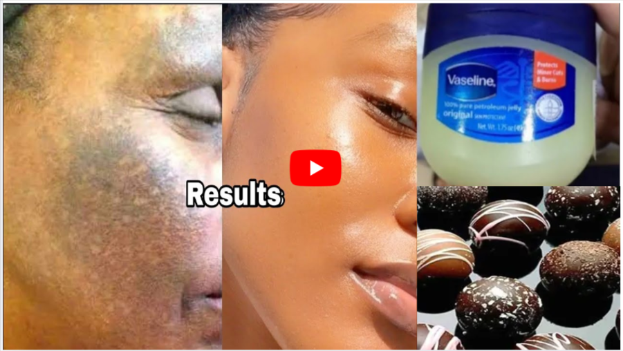 VaselineWith Chocolate For Vitiligo