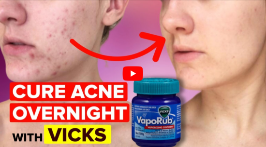 Vicks Vaporub Acne