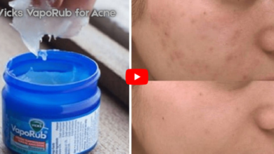Vicks Vaporub For Acne