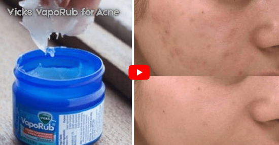 Vicks Vaporub For Acne
