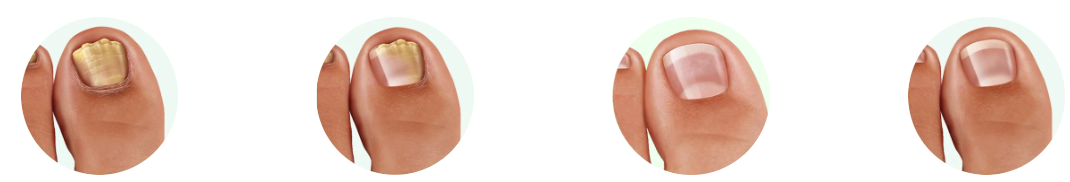 Dermafix Nail Fungus Treatment Gel benefits