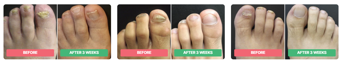 Dermafix Nail Fungus Treatment Gel customer reviews