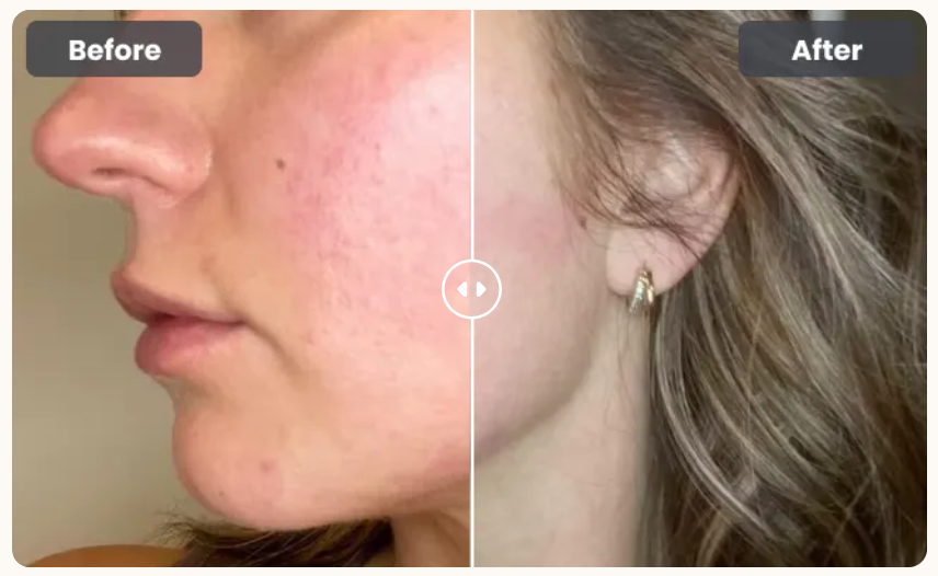 Glokore LED Skin Sculptor results