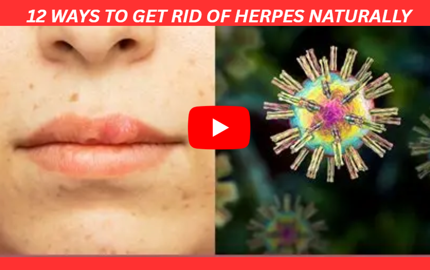 12 Ways to Get Rid of Herpes Naturally 1