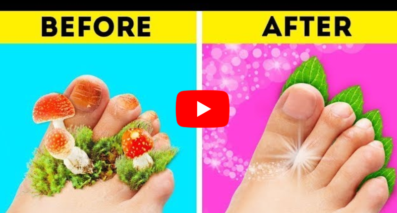 12 Ways to Get Rid of Toenail Fungus Naturally & Fast at Home 2