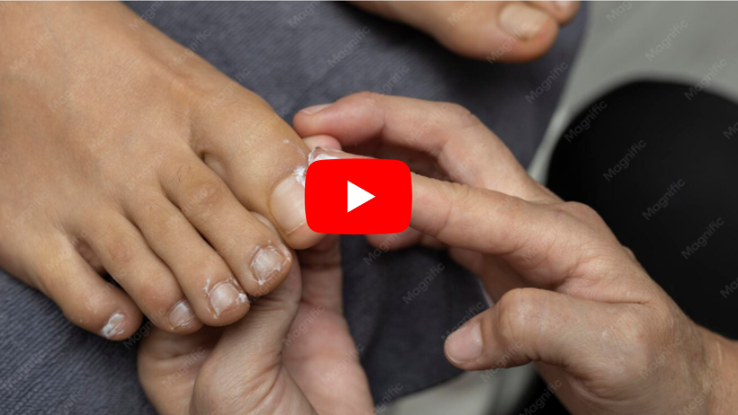 NAIL FUNGUS 1