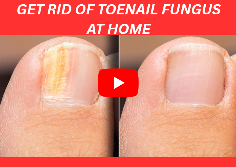 NAIL FUNGUS IMAGE
