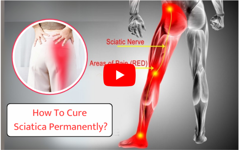 sciatia cure naturally